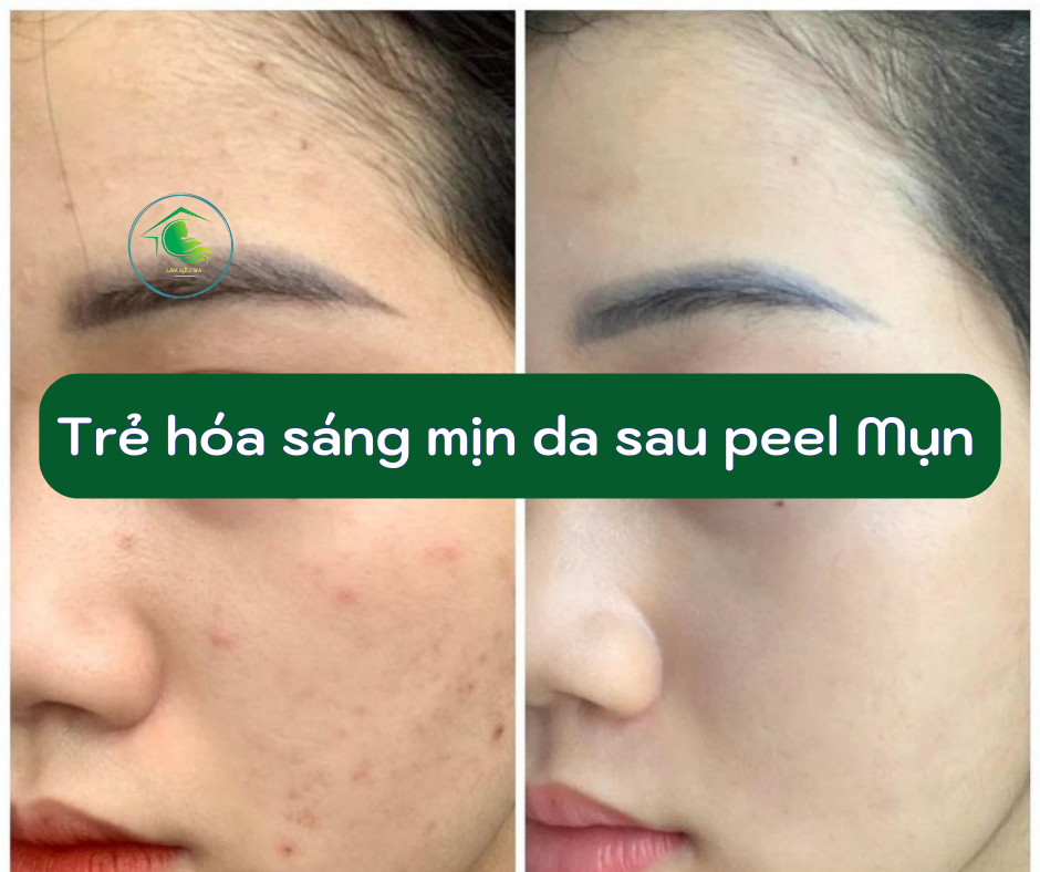 peel mụn vũng tàu