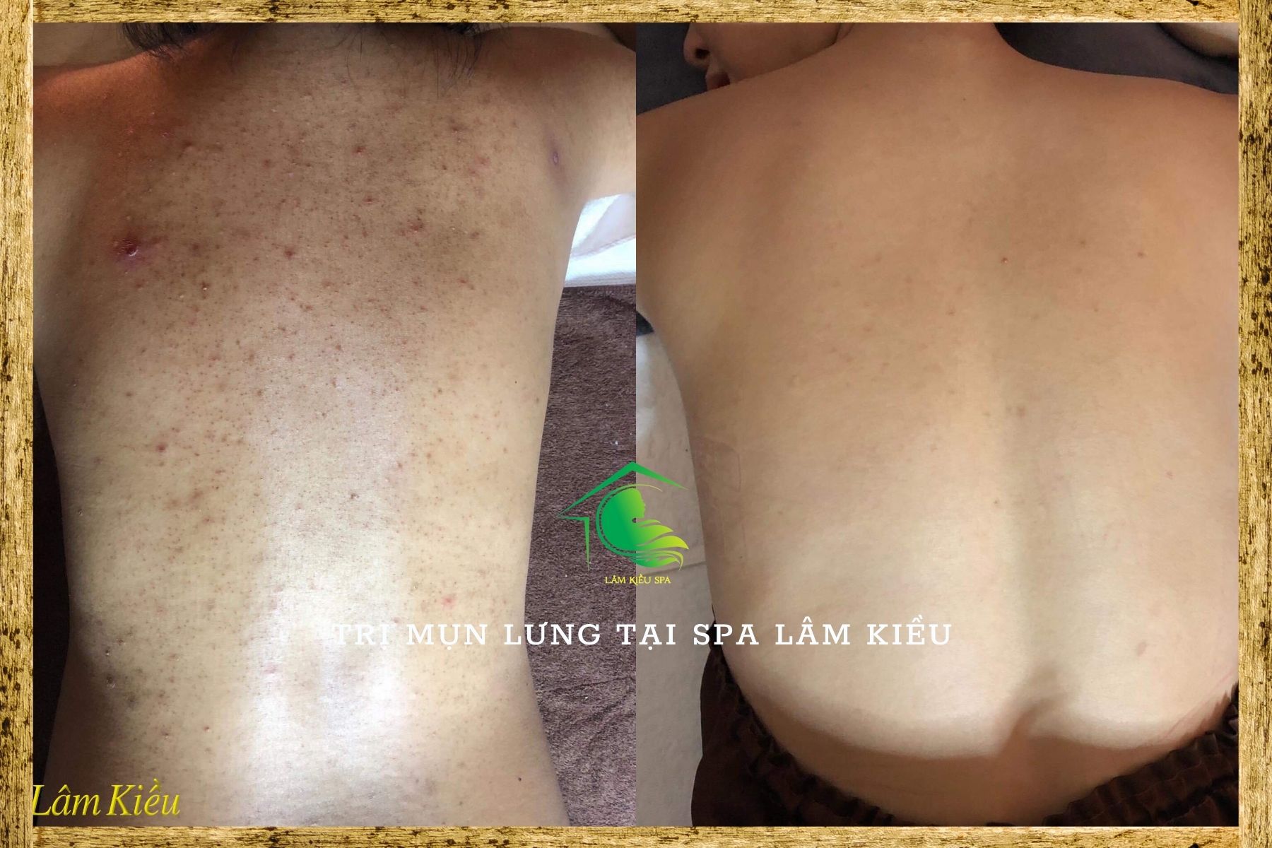 Trị mụn lưng tại tây ninh