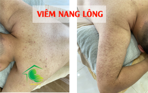 Viêm nang lông thường bị ở vùng bắp tay - ngực- lưng